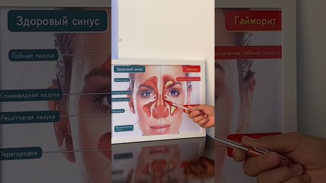 Гайморит лечения укол / даарысыз 100% смотреть онлайн