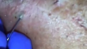 Удаляем черные точки blackhead removal