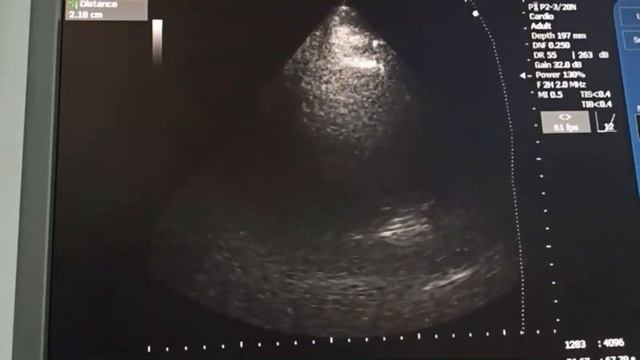 Липоматозная гипертрофия межжелудочковой перегородки Тромб в ушке левого предсердия смотреть онлайн