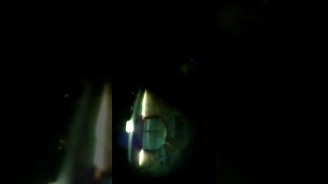 Гипертрофия пигментной каймы зрачка? смотреть онлайн