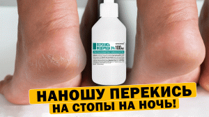 Вот что произошло после 2-х раз! Перекись на стопы лечит даже...