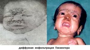 Дифференциальная диагностика эпидемической  пузырчатки новорожденных