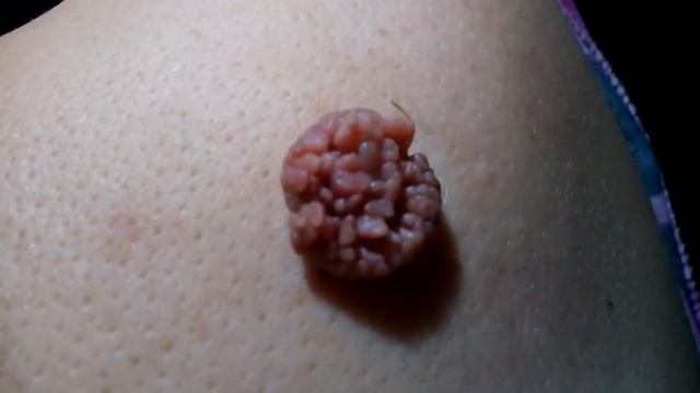 ПАПИЛЛОМАТОЗНЫЙ НЕВУС - ЛЕЧЕНИЕ. День 22 смотреть онлайн