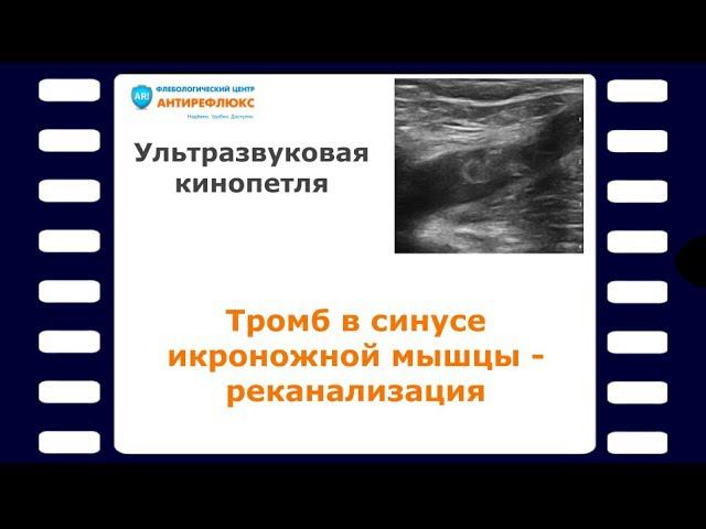 Тромб в синусе икроножной мышцы - реканализация