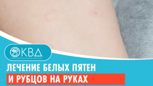 ✅ Лечение белых пятен и рубцов на руках. Клинический случай №800