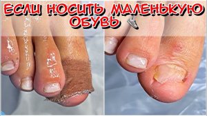 Что будет если носить маленькую обувь / Что с ногтем? Грибок ногтей?