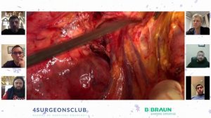 Панкреатодуоденальная резекция при раке ДПК