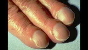 Болезни ногтей с примерами на фото. Часть 2
