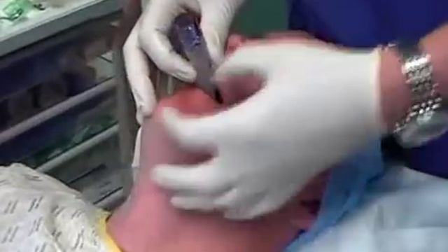 Техника установки ларингеальной маски