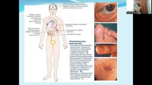 ИНФЕКЦИОННЫЙ ЭНДОКАРДИТ