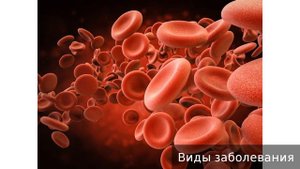 Полицитемия истинная. Как лечить полицитемию истинную.