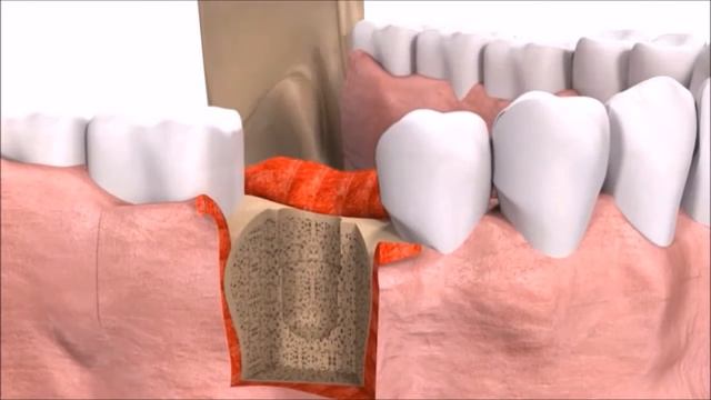 Зубные импланты. Имплантация зубов в клинике "Снежана" смотреть онлайн