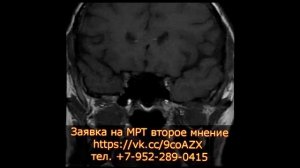 Микроаденома гипофиза параселлярно справа на МРТ второе мнение выполненной проф. Холиным А.В.