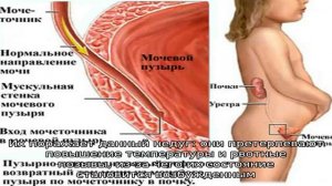 Острый пиелонефрит у детей