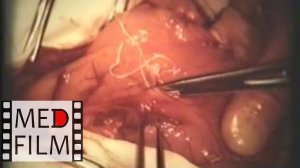 Передняя серомиотомия желудка в сочетании с задней селективной ваготомией © Front serozomiotomiya