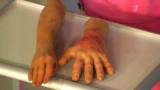 Зимние боли. Аллергия на холод. Жить здорово! Фрагмент выпуска от 12.01.2015 смотреть онлайн