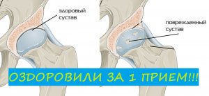 Исцелили коксартроз тазобедренного сустава за 1 прием! История Елены
