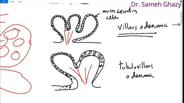 Systemic pathology 37 : GIT 7 (tumors of intestine ) DR.SAMEH GHAZY смотреть онлайн