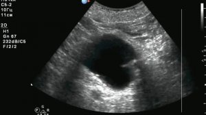 камень устья мочеточника