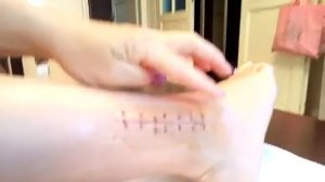 Перелом голеностопного сустава .Продолжение. Сняли швы.