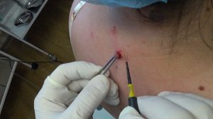 Два папилломатозных невуса.