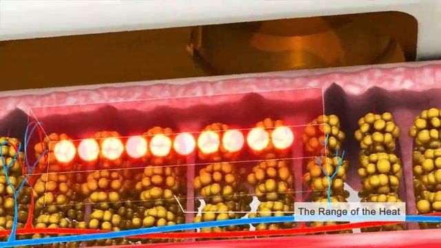 ULTRAFORMER III Featured смотреть онлайн