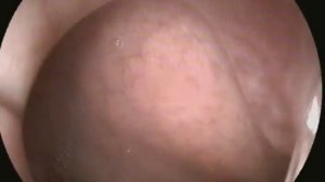 ЭГДС Язва Желудка (gastric ulcer)