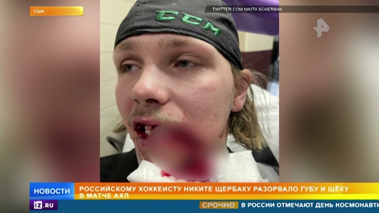 Российскому хоккеисту разорвало рот в матче АХЛ