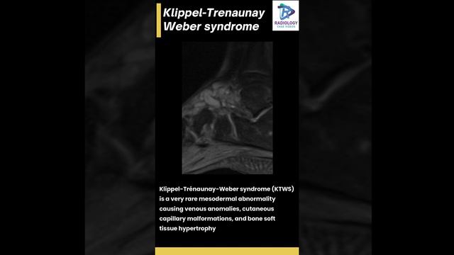 Klippel Trenaunay weber syndrome