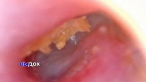 зияние слуховой трубы