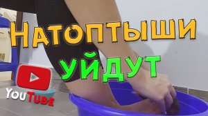 Как избавиться от натоптышей