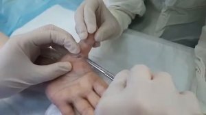 Рассечение кольцевидной связки.