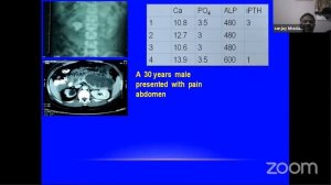 Indian PHPT registry - Epidemiology to Epigenetics by Dr. Sanjay K Bhadada