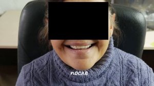 Полный съёмный акриловый протез.