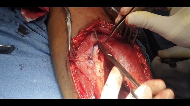 Humerus Plating with Posterior Approach Detailed Step by Step Approach