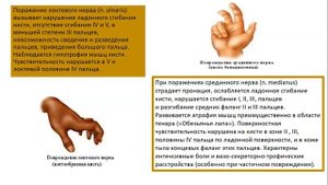 Травмы нервов верхней конечности