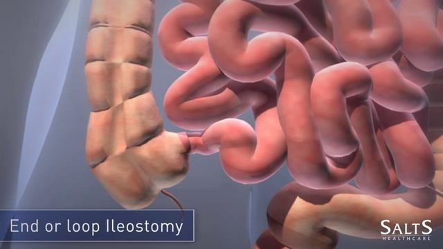 What is an Ileostomy? смотреть онлайн