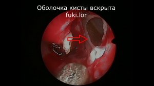 Киста верхнечелюстной пазухи и синуслифт, лор-операция, ЛОР-хирург к.м.н. Фуки Евгений Михайлович