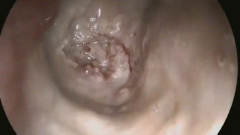 ЭГДС Рак Желудка (stomach cancer)