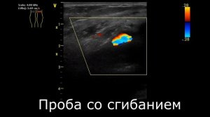 Киста Бейкера и подколенная артерия на УЗИ