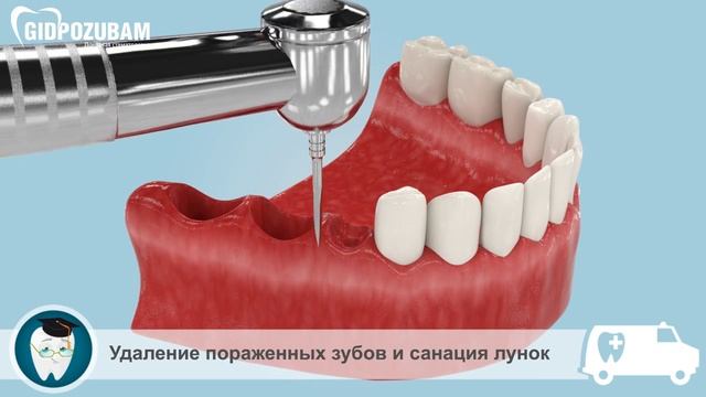Одноэтапная имплантация зубов. Проведение имплантации сразу после удаления зуба смотреть онлайн