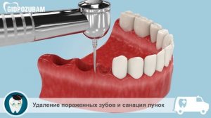 Одноэтапная имплантация зубов. Проведение имплантации сразу после удаления зуба