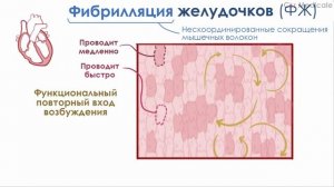Фибрилляция желудочков