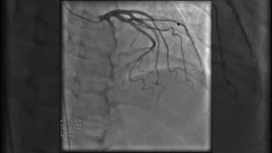 Коронарография и ее проекции
