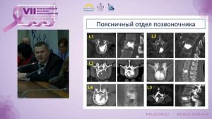 Борзов К.А. | Метастазы в позвоночник: приговор или диагноз. Современные тенденции лечения