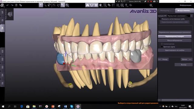 Расстановка зубов перед имплантацией_2 Avantis 3D смотреть онлайн