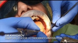 Dr. Khvorov. Установка имплантов Osstem