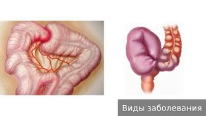 Заворот кишок. Как лечить заворот кишок.