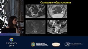 Дифференциальная диагностика объемных образований яичников по данным МРТ. Трофименко И.А.