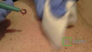 Crumbly Back Cyst | Dr. Derm